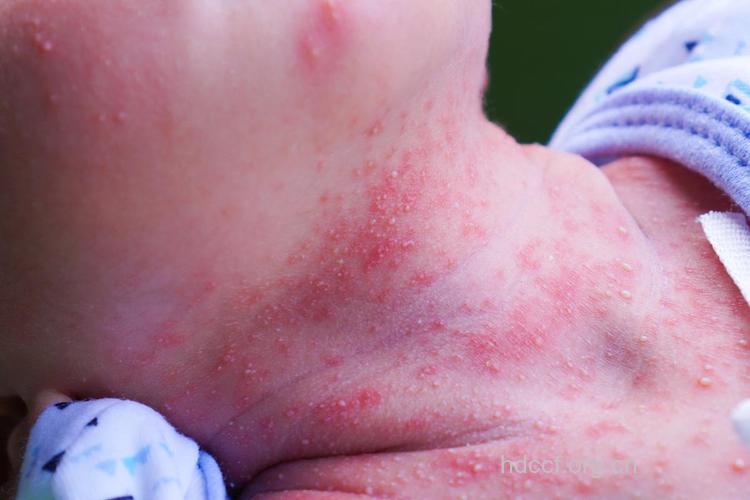 痱子的症状 婴儿痱子症状图片