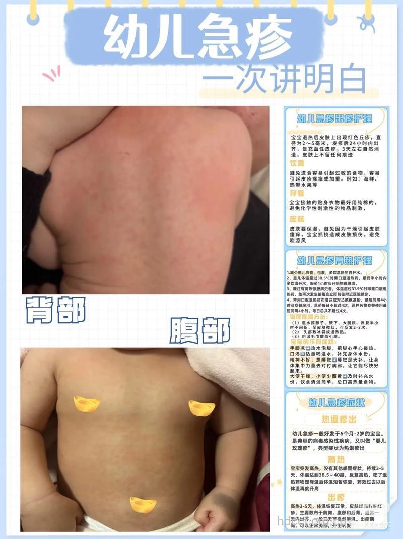 宝宝发烧后出疹子怎么办