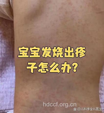 惊！孩子感冒症状是皮肤病前兆？