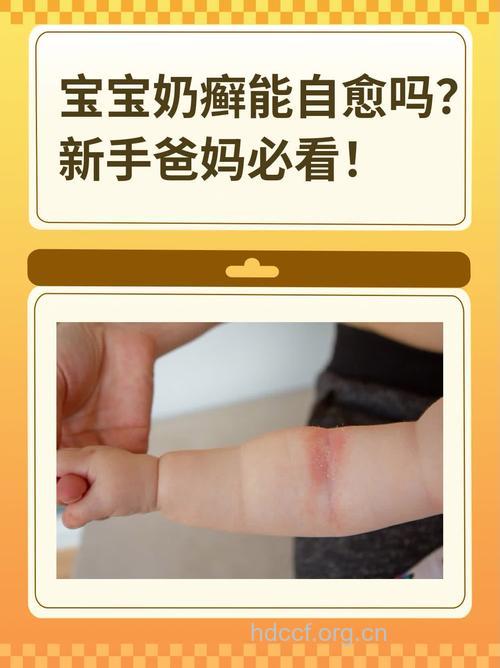 宝宝得了“奶癣”可以抹牛奶吗？