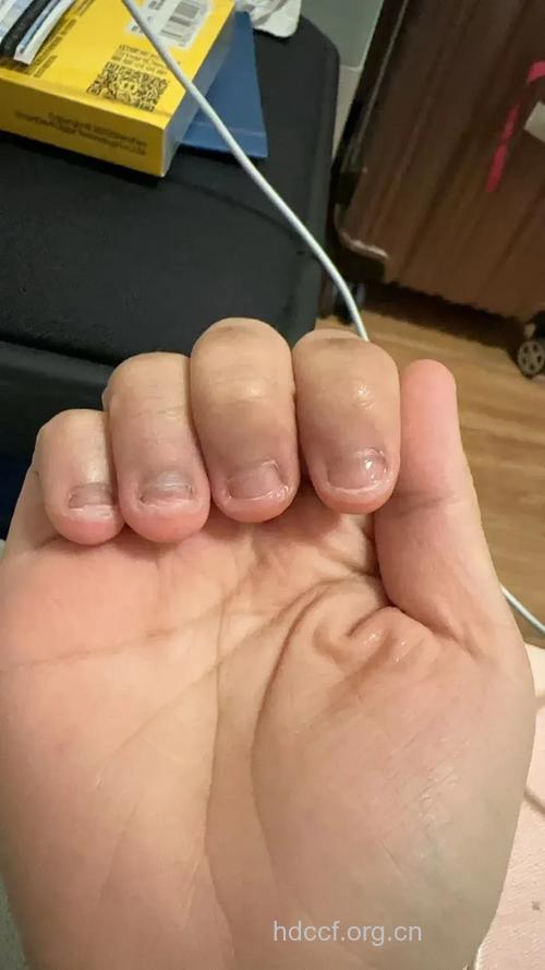 小孩子经常咬指甲有什么样的后果？