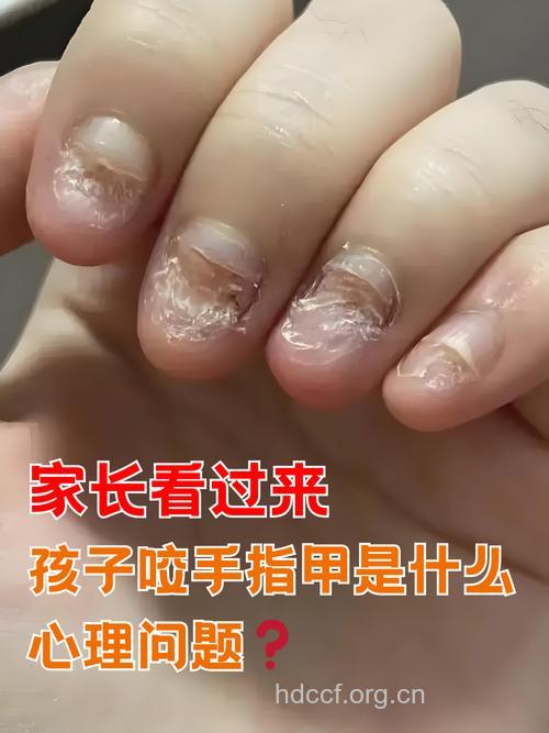 孩子咬指甲好动警惕疾病信号