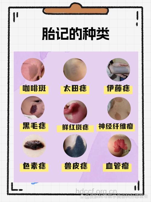 宝宝胎记会自行消退吗？