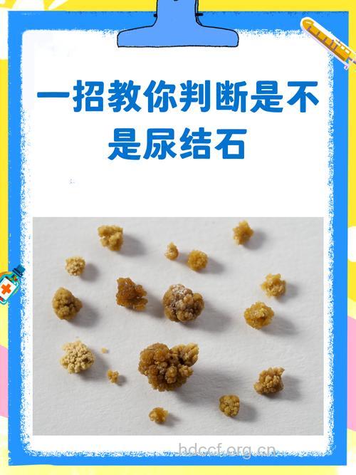 孩子尿少尿不出是肾结石吗？