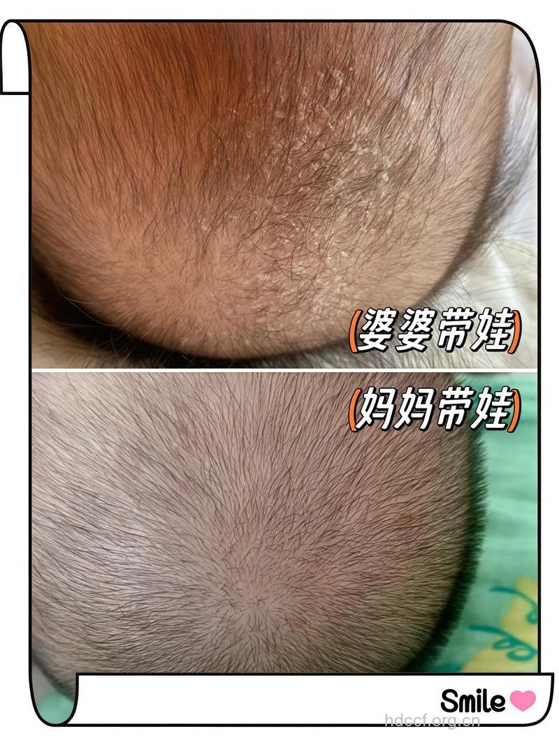 孩子头皮上结厚痂 父母怎么处理?