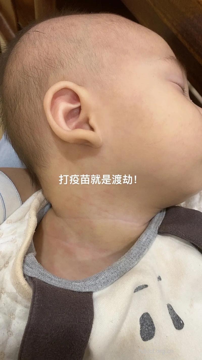 不宜接种麻疹疫苗的孩子