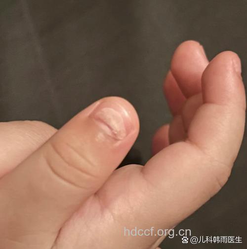 宝宝指甲六个信号透露健康