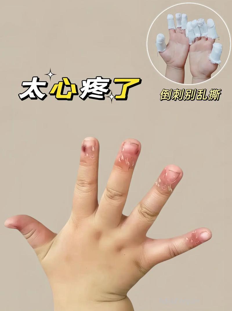 宝宝长“倒刺”要多吃水果