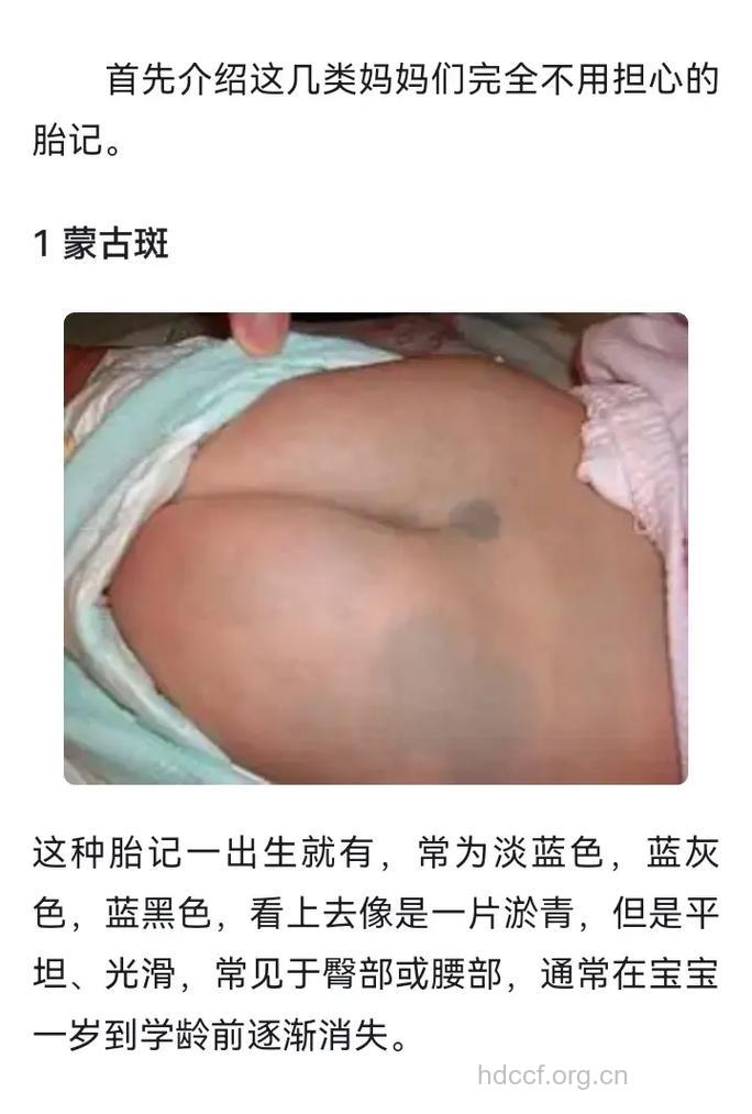 教你在怎么从胎记看宝宝的健康