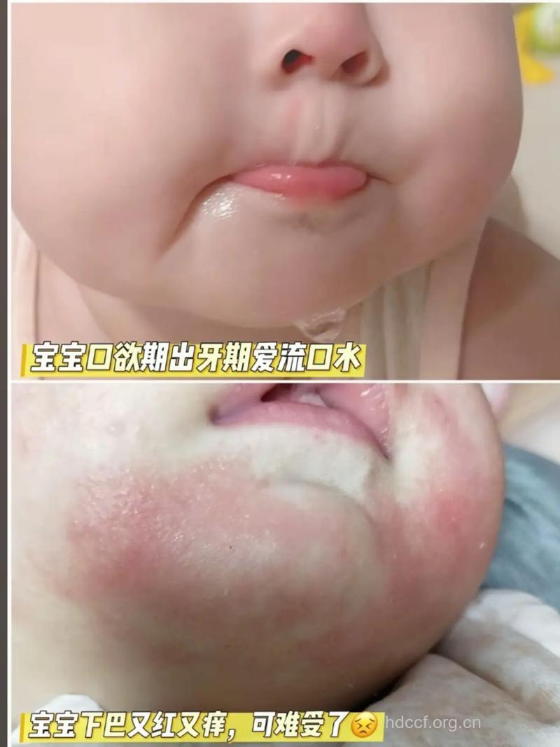 为什么宝宝夏季爱流口水