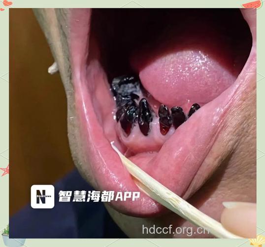 孩子爱喝饮料导致蛀牙