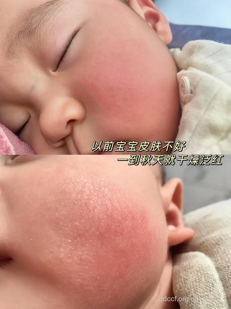 秋季宝宝皮肤干燥多补充维生素A