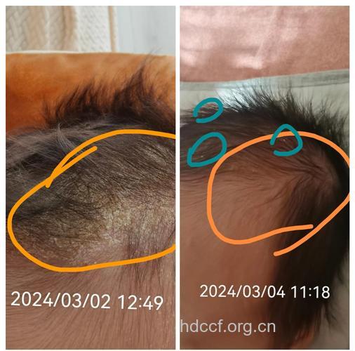 宝宝生啥病?从头发寻根