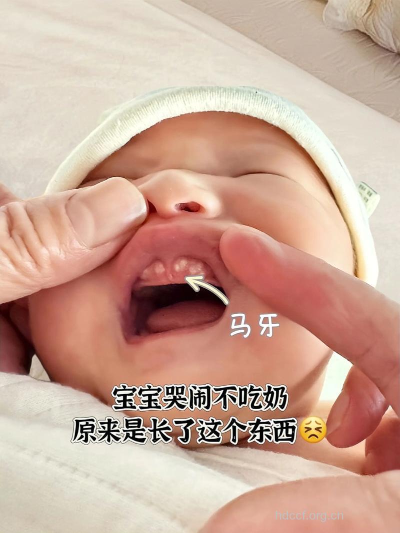 莫用针挑宝宝的“马牙”