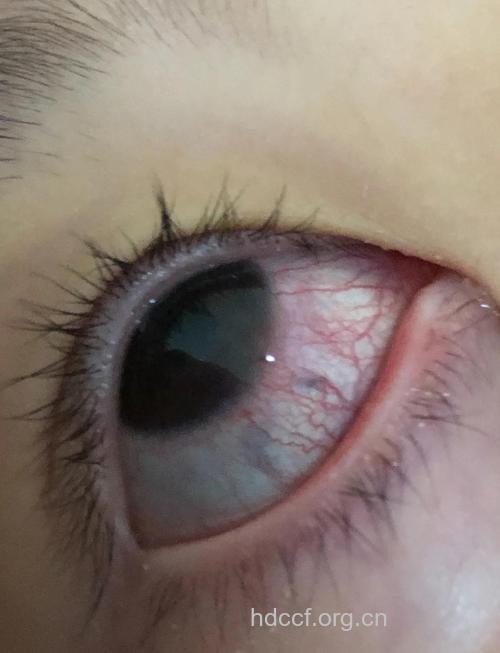 小儿红眼病这个季节最流行