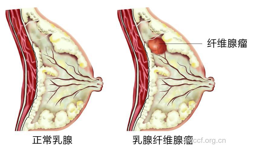 乳腺纤维瘤能怀孕吗
