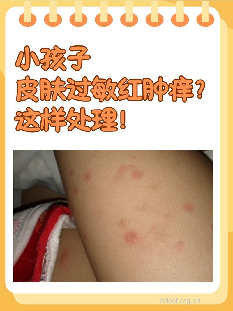 阳春三月 小儿皮肤过敏如何是好?