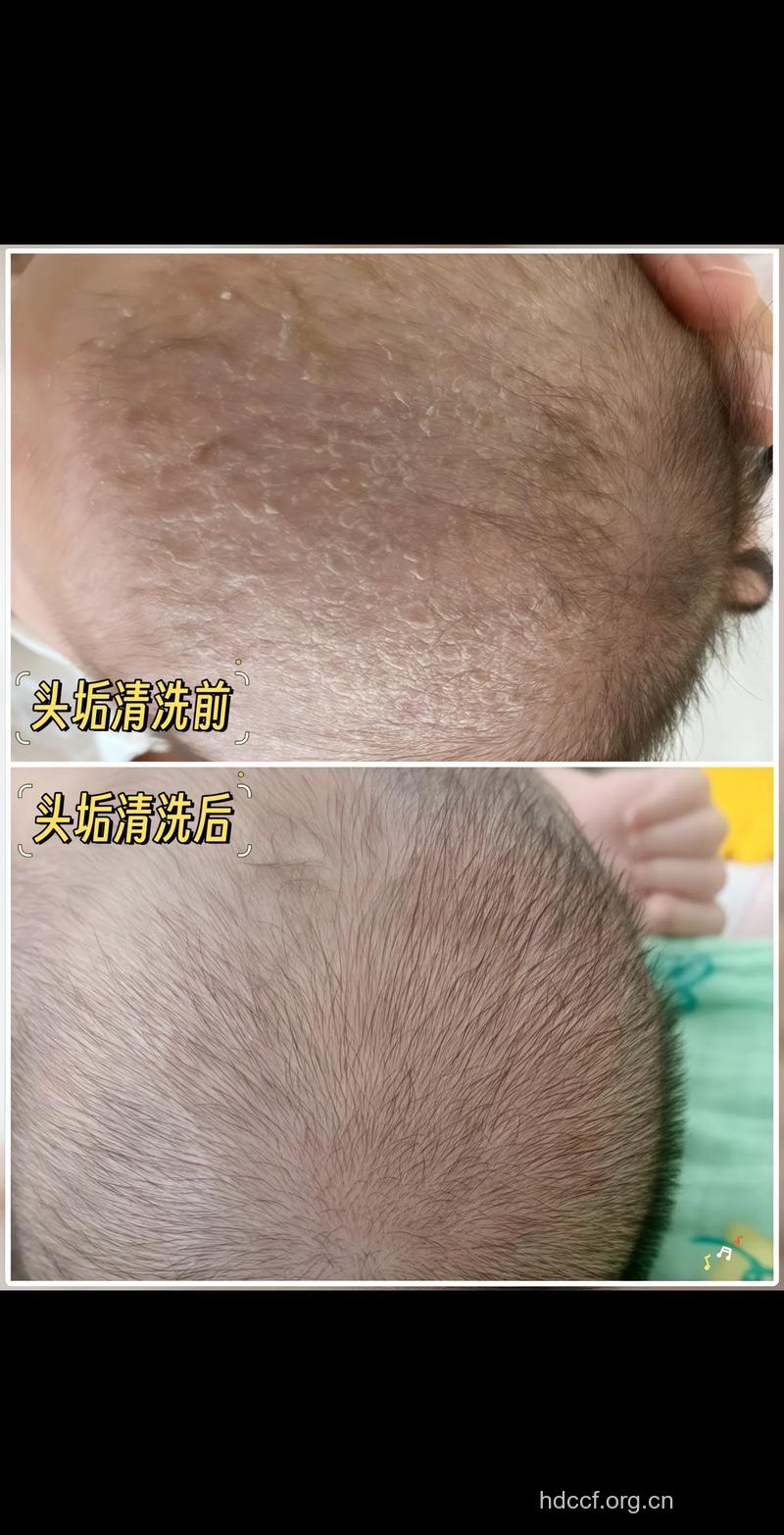 清除孩子头上的胎垢有何妙招