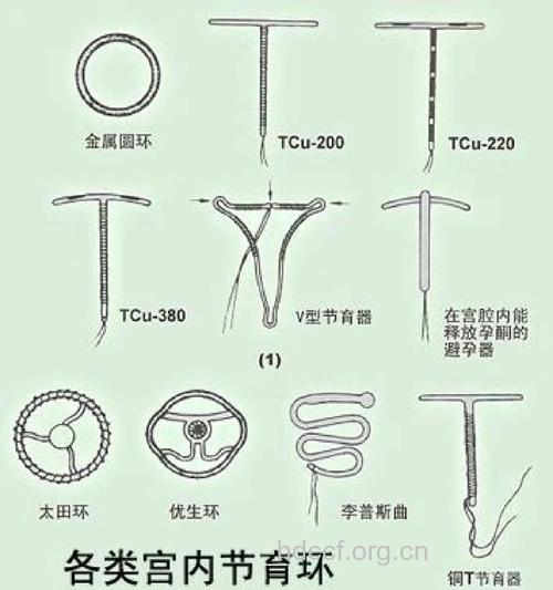 避孕环的种类到底有哪些