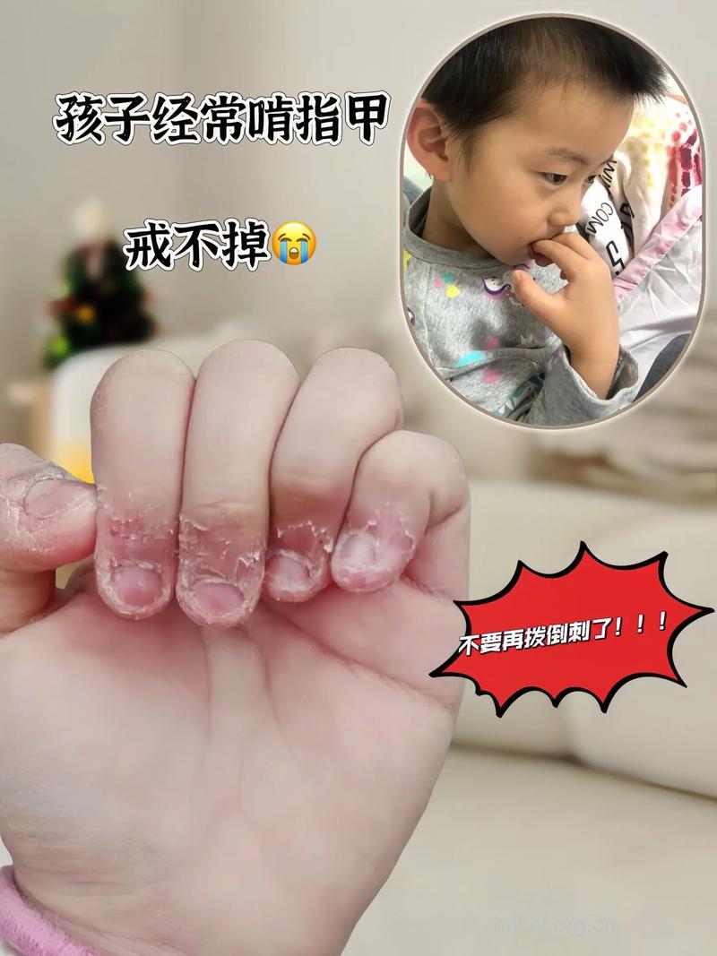 警惕:宝宝为何咬指甲?