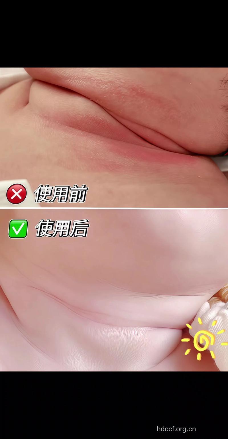 妈咪呵护婴儿的敏感部位有妙招