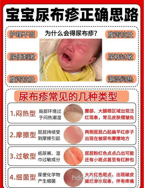 尿布疹危害大 6大护理注意事项