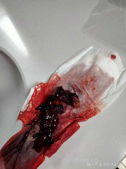 怀孕初期流产有什么症状