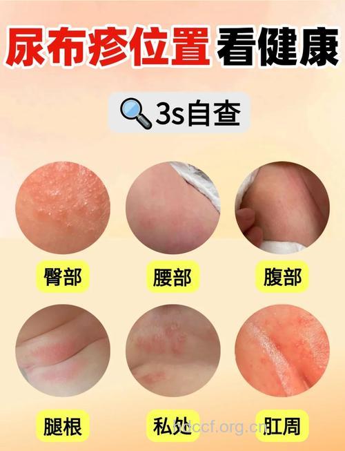婴儿尿布疹的日常预防和食疗