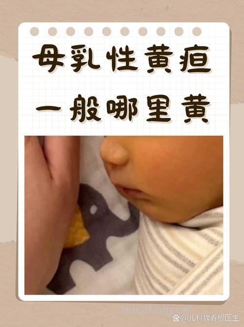 宝宝遭遇传说中的母乳性黄疸
