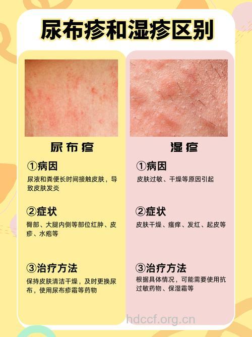 尿布疹容易与哪些疾病混淆