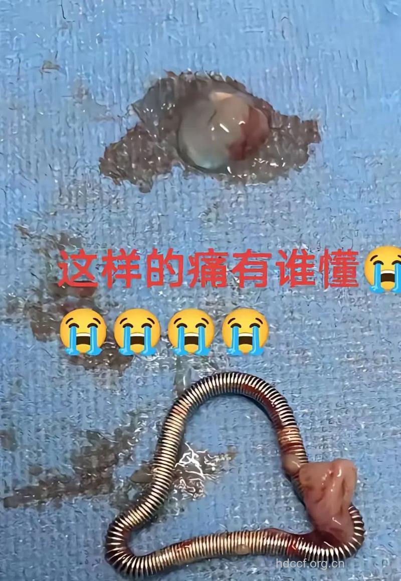 什么情况下要取出避孕环