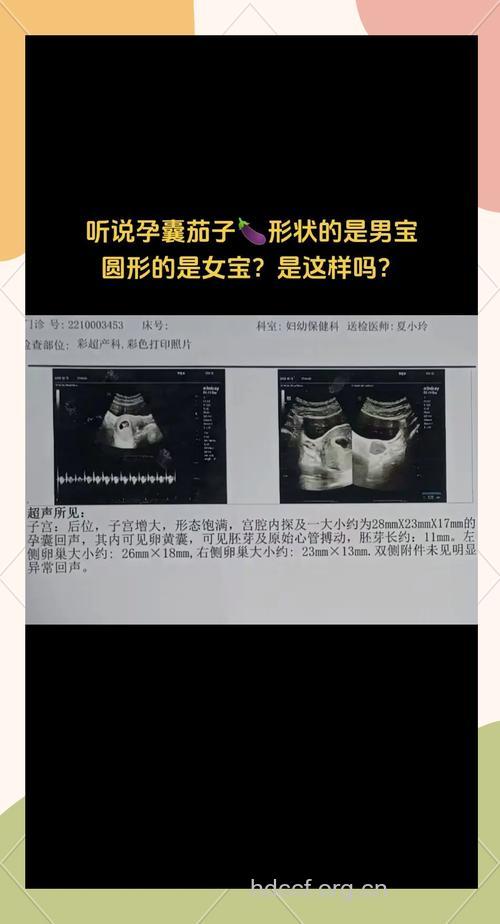 孕囊形状看性别准吗 长条为男孩？