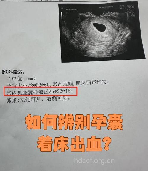 孕囊着床出血是男孩吗 生男生女预测方法