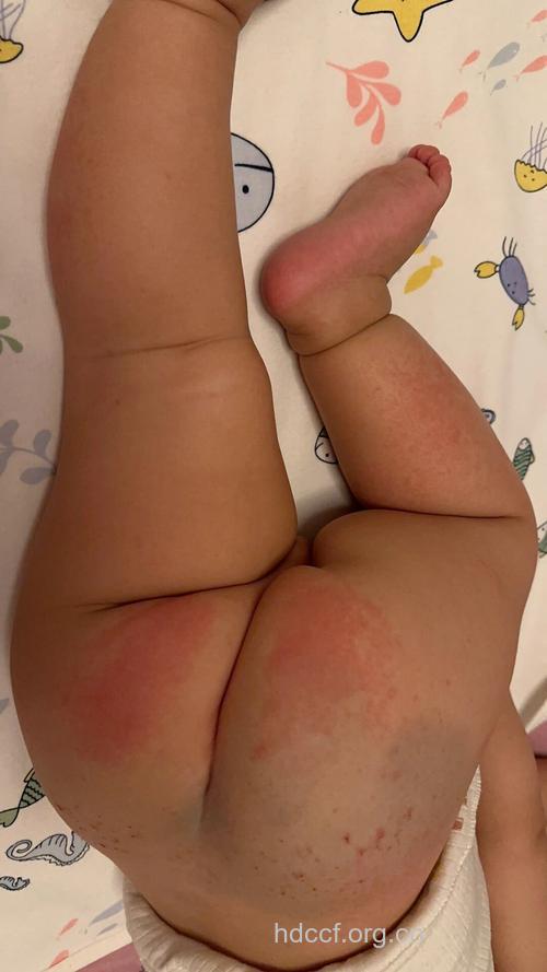 宝宝用“尿不湿”易得红屁股