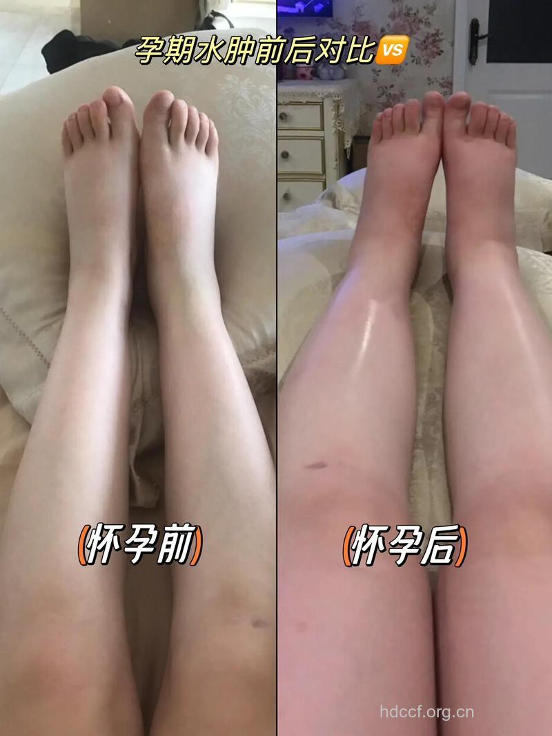 孕期水肿别着急 吃它们还你一双美腿
