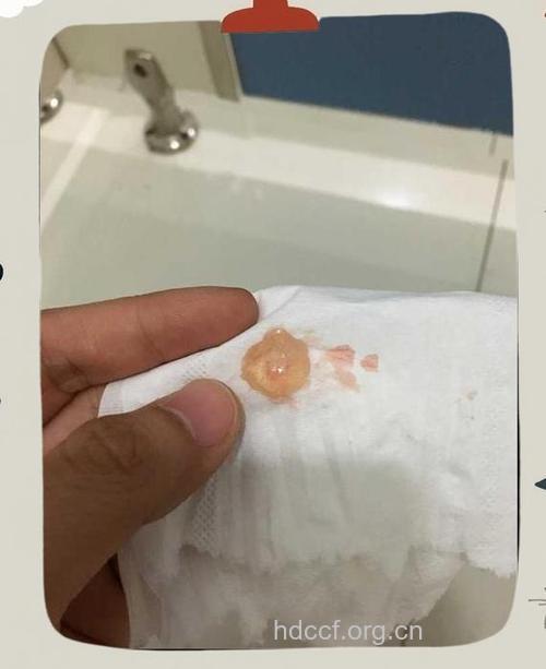 药流打胎后没有看到孕囊排出怎么办