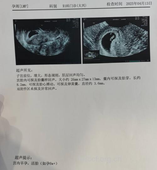 孕早期检查 孕囊细长应当心流产