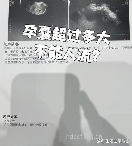 孕囊多大可以人流 孕囊过小不可手术