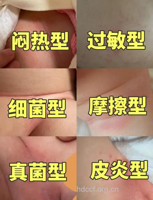 宝宝尿布疹引发小痘痘如何处理？