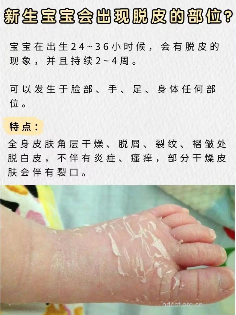 支招：处理新生儿脱皮