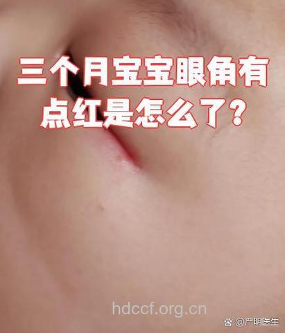 支招：处理新生儿眼睛发红