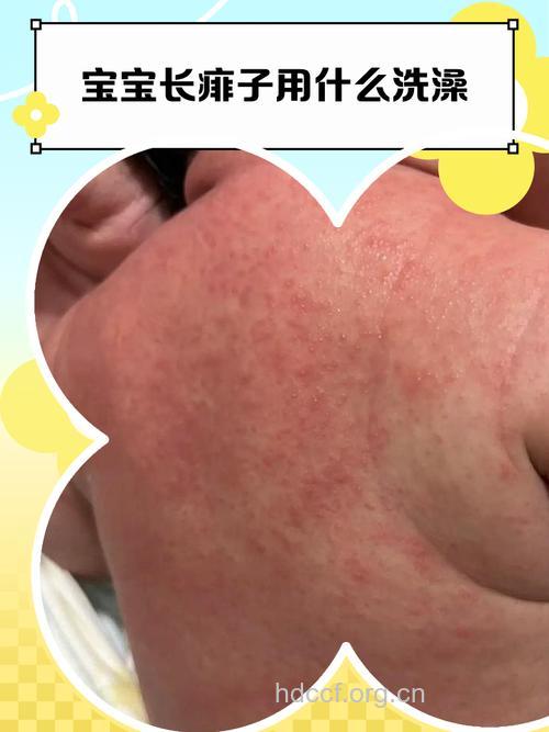宝宝痱子有什么类型
