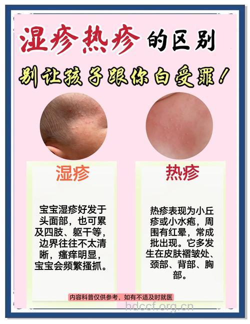 小儿湿疹如何护理最好