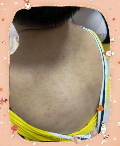 小儿急性湿疹的症状