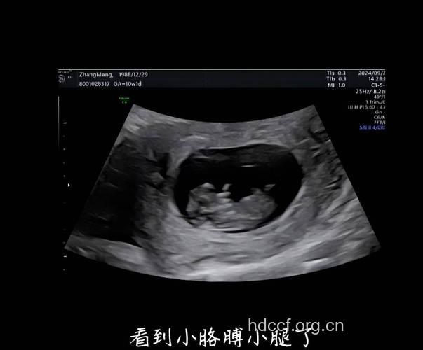 从B超单上可看出生男生女