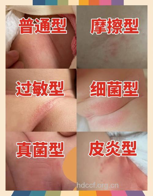 小儿得了尿布疹怎么办