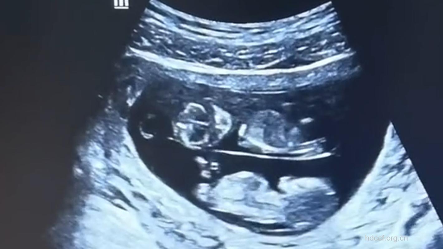 怀孕第8周双胞胎B超图
