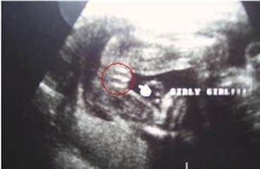 从B超数据看生男生女