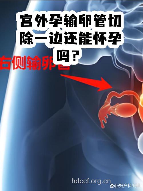 宫外孕切除一侧输卵管好孕经验分享