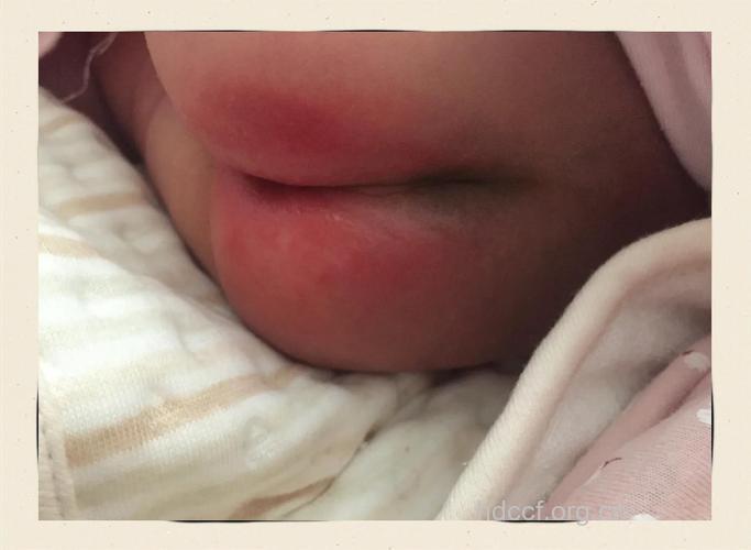 什么是宝宝红屁股？